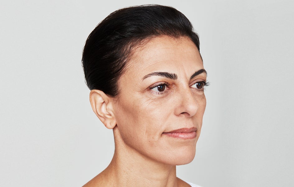 A woman's frown lines before treatment