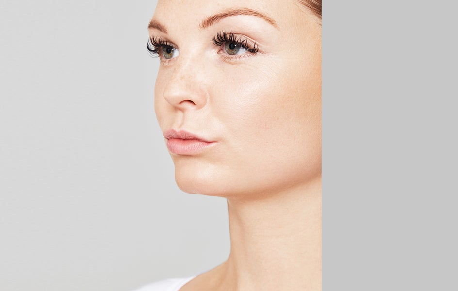 A woman's cheeks and lips before dermal fillers