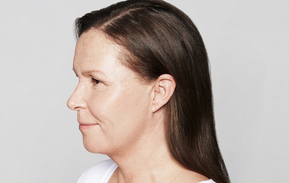 A woman's cheeks after skin booster treatment