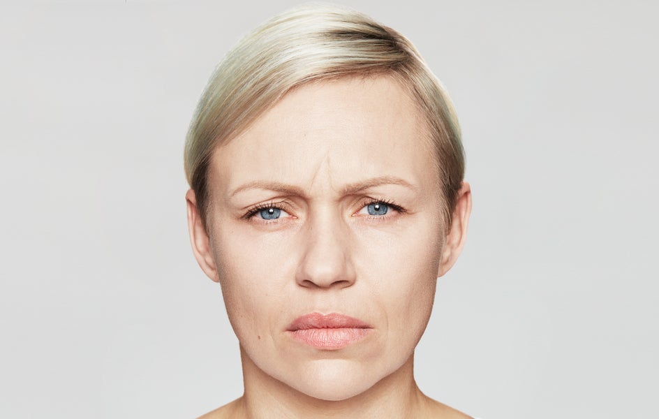 Women's forehead lines before wrinkle treatment