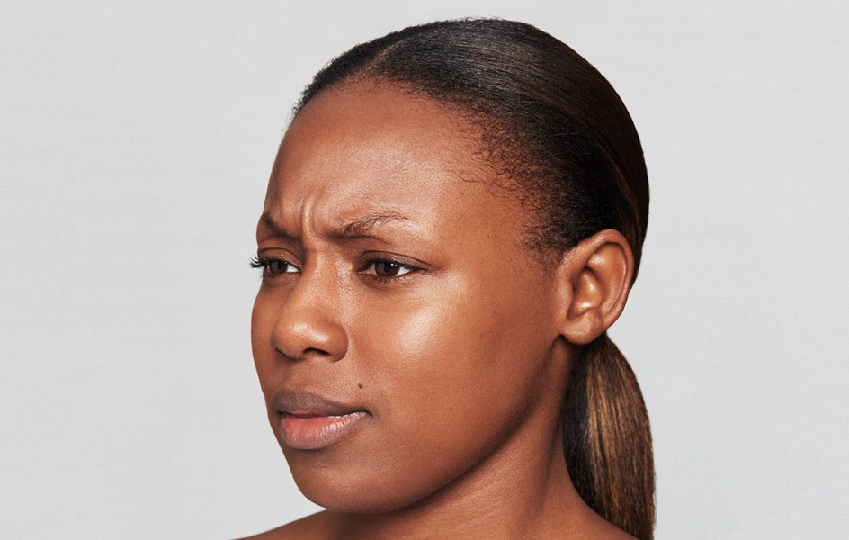 A girl's face before treatment for frown lines