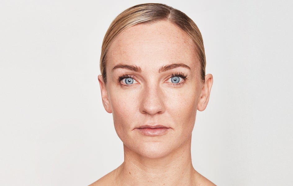 A woman's face after receiving anti-wrinkle treatment